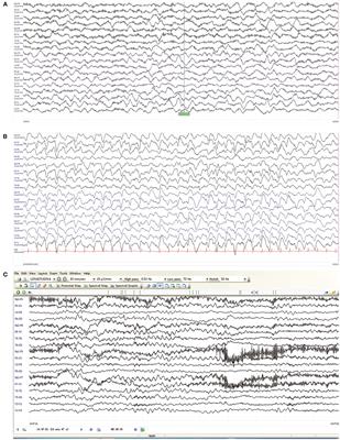 Case Report: Triphasic Waves in a 9-Year-Old Girl With Anti-NMDAR Encephalitis